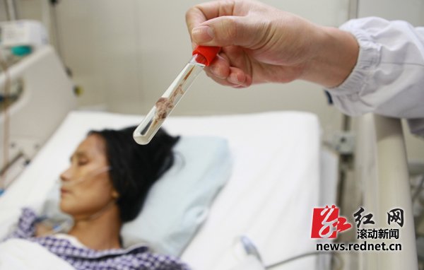 聾啞婦女心臟內取出一根6厘米長牙簽(圖)