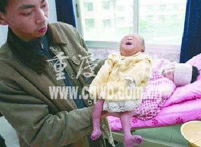 重慶一名農(nóng)婦產(chǎn)下畸形男嬰 雙腿一正一反(圖)